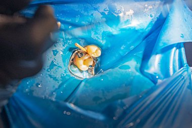 Dişçi hastanın dişlerinin arasına bir diş aleti yerleştirir. Diş bakımı ve sağlık