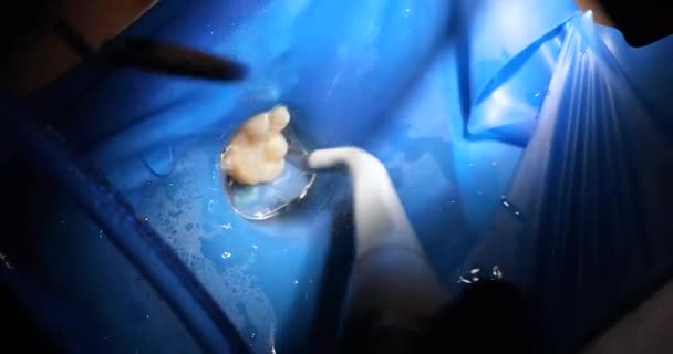 Tandarts Kijkt Een Kleine Spiegel Gerestaureerde Tand Tijdens Behandeling Tandheelkundige — Stockvideo