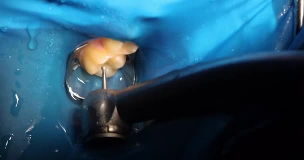 Dentista Faz Buraco Dente Doente Com Uma Máquina Rebarba Cuidados — Vídeo de Stock