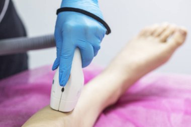 Kozmetik uzmanı, hastanın bacaklarındaki fazla kılları lazerle alıyor. Lazer tüy aldırma, özen ve öz bakım.