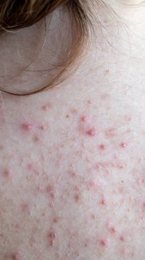 Sivilceli, kırmızı lekeli, cilt hastalıklı bir kadın. Yüksek kalite fotoğraf