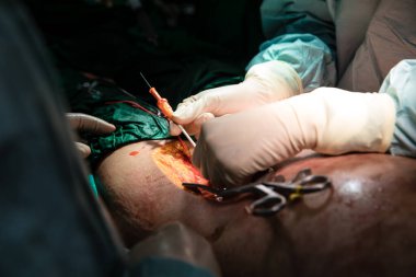 Close up surgeon in operating room practice performing stop bleeding by REBOA (Resuscitative Endovascular Balloon Occlusion of the Aorta) technique
