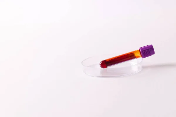 ペトリ皿の血液サンプルチューブ コピースペースと白の背景に 血液健康診断 — ストック写真