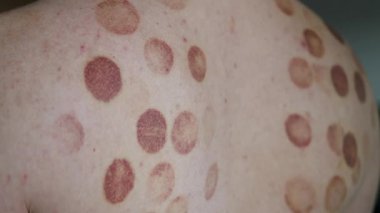 Sırtında terapi izleri olan beyaz bir adam alternatif tıp tedavisinin iyileşme sürecini gösteriyor. Tedavinin uygulanması, sağlığın geliştirilmesi ve...