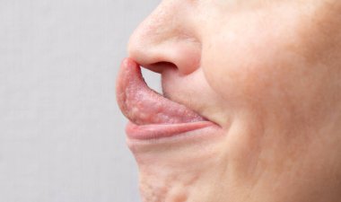 The Gorlin sign is a medical term that indicates the ability to touch the tip of the nose with the tongue. Might be the sign of EhlersDanlos syndrome. clipart