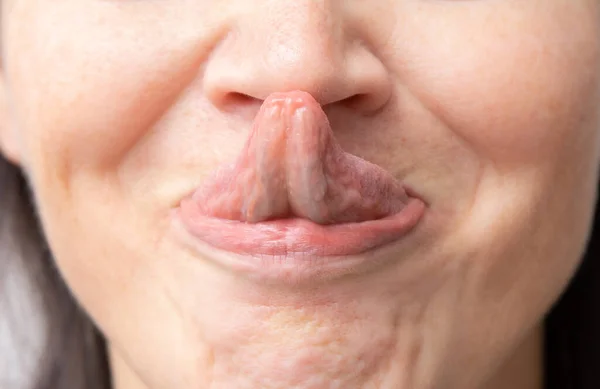ゴリン記号 Gorlin Sign 鼻の先端に舌で触れる能力を示す医学用語である エルサレス ダンロス症候群の兆候かもしれない — ストック写真