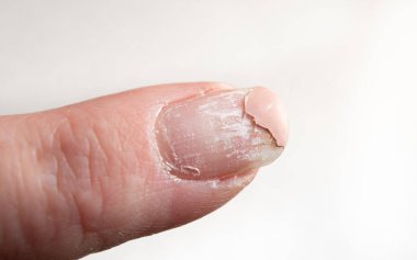 Ultraviyole oje kullandıktan sonra zarar gören tırnakların katmanlarını kapat. Evin içinde..