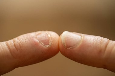 Onikofaji. Tırnağı yenmiş parmakları kapat. Endişe ve sinirlerin etkileri.