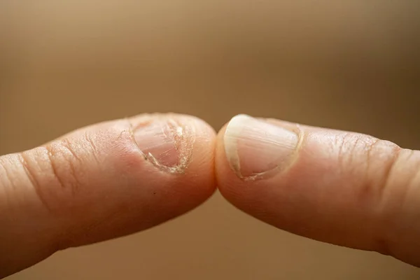 Onychophagy Închideți Degetele Unghiile Mâncate Efectele Anxietății Nervilor — Fotografie, imagine de stoc