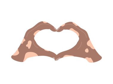 Beyaz arka planda izole edilmiş iki vitiligo derisinden yapılmış aşk işareti. Dünya Vitiligo Günü farkındalığı. Aşk kavramı, destek, çeşitlilik. Sevgililer günün kutlu olsun, romantik çift.