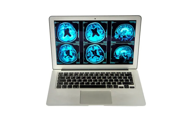 Beyin hastalıklarının nörolojik teşhisi için insan beyninin bilgisayar ekranındaki manyetik rezonans görüntülemesi.