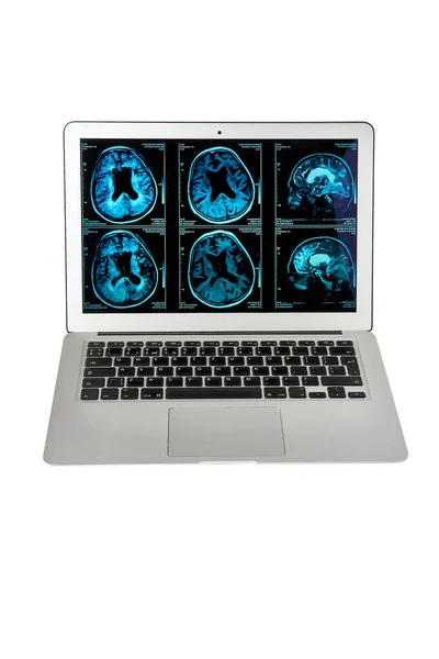 stock image Magnetic resonance imaging of the human brain on a computer screen, for neurological medical diagnosis of human brain diseases.