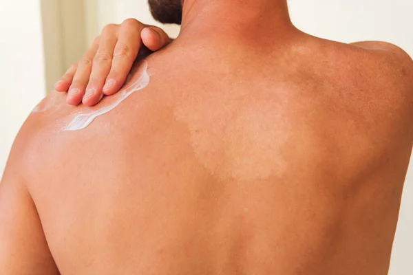 隐姓埋名的男性在肩部皮肤护理过程中涂防晒霜的背景图 — 图库照片