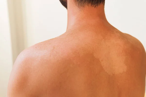 Hombre Sin Rostro Con Espalda Desnuda Con Quemaduras Sol —  Fotos de Stock