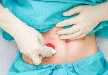 A young Caucasian male patient in medical disposable pajamas and in sterile surgical white gloves wipes with a dry cloth around the colon to replace the colon after surgery at home, flat lay close-up. Medical concept, abdominal diseases, surgery, ste
