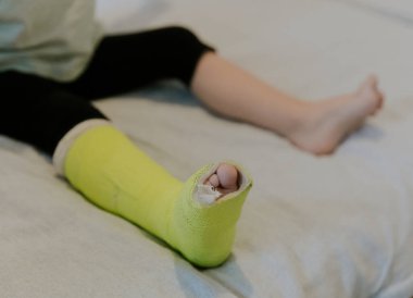 Beyaz tenli küçük bir kızın bacağında yeşil alçı var. Sabahın erken saatlerinde yatakta oturuyor. Seçici bir odak noktasıyla yakın plan..