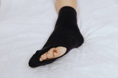 Kırık ayak parmağının sol ayağında siyah çorapla, beyaz bir yatakta yatan beyaz bir kadının deliğiyle yakın plan görüntüsü. Çivi tedavisi kavramı.
