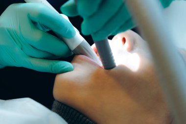 Yeşil lateks eldivenli genç bir beyaz kadın dişçi özel bir klinikte diş aletleri kullanan bir kızın ağzındaki diş etlerini duruluyor. Alt tarafı seçici bir odak ile çok yakından görülüyor. Diş eti ve diş eti tedavisi kavramı