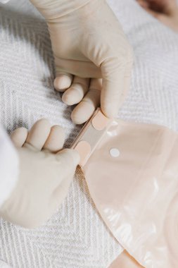 Steril eldiven takmış, temiz kolostomi torbasını hastaya kapatan, gündüz vakti klinik koğuşunda ayakta duran, üst tarafı çok yakın çekim yapan, tanınamayan beyaz yaşlı kadın doktorun dikey portresi. Abdominal hastalıklar, hemşire hizmetleri.