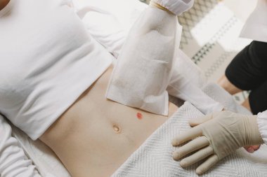 Gündüz vakti klinik koğuşunda kolostomi torbası için tek kullanımlık ıslak eldiven hastalarını temizleme işlemi sırasında steril eldiven takan tanınmamış beyaz kadın doktor portresi. Karın hastalıkları.