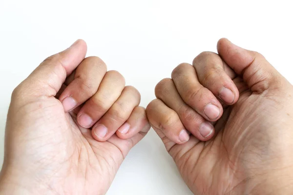 Dirty nails of girl on white background.