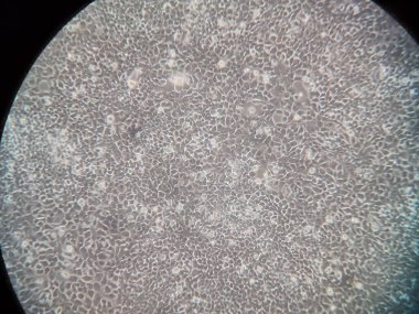 Mikroskop altında ağız kanseri hücreleri