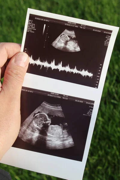 stock image Ultrasound of a child in his father's hands