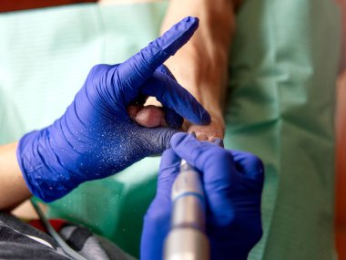 Ayak hastalıkları tedavisine yakın çekim. Seçici odak