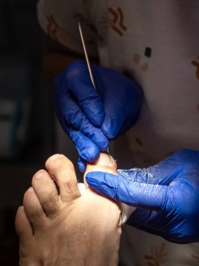 Ayak hastalıkları tedavisine yakın çekim. Seçici odak