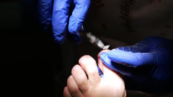 Close Podiatry Treatment Darkness Selective Focus — Stock Video