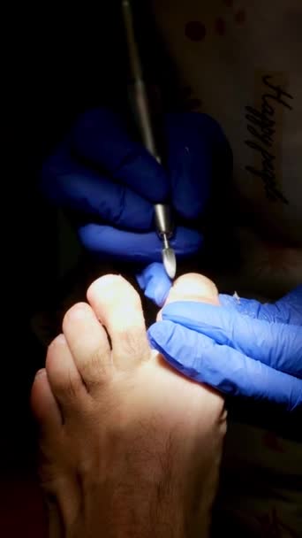 Close Podiatry Treatment Darkness Selective Focus — Stock Video
