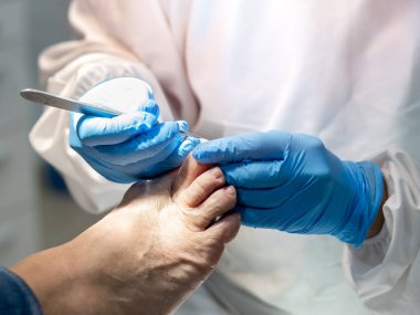 Ayak hastalıkları tedavisine yakın çekim. Seçici odak