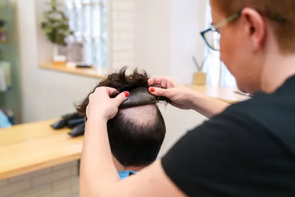 Профессиональная Установка Натурального Протеза Волос — стоковое фото