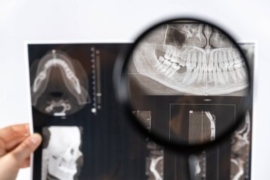 Doktor, temporomandibular eklem bozukluğu ve maloksiyonu olan bir hastanın tomografisini tutuyor.