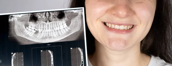 Maloksyonu Olan Bir Hasta Çiğnenen Diş Temporomandibular Eklem Bozukluğu Olan — Stok fotoğraf