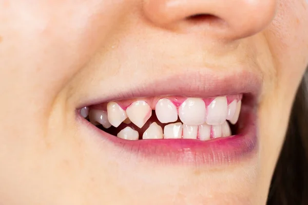 Placa Dentes Humanos Colorido Rosa Com Comprimidos Indicadores — Fotografia de Stock