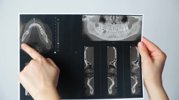 Médico Mostrando Tomografia Computadorizada Paciente Com Disfunção Temporomandibular Oclusão — Vídeo de Stock