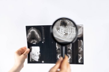 Doktor, temporomandibular eklem bozukluğu ve maloksiyonu olan bir hastanın tomografisini tutuyor.