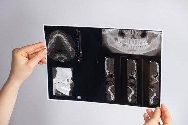 The doctor holds a CT scan of a patient with temporomandibular joint dysfunction and malocclusion clipart