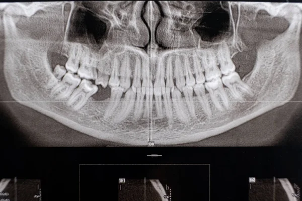 Tomografia Computadorizada Paciente Com Dente Mastigatório Ausente Oclusão — Fotografia de Stock
