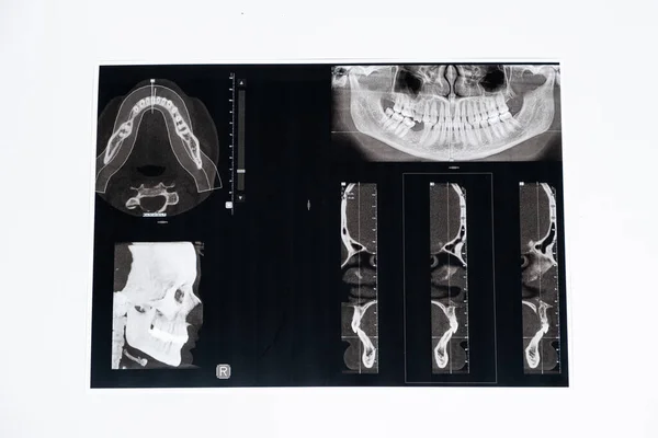 Tomografide Malocclusion Diş Temporomandibular Eklem Bozukluğu Olan Bir Hastanın Tomografisi — Stok fotoğraf