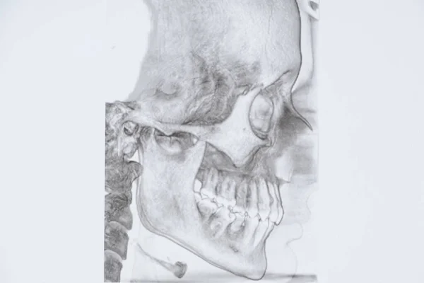 Tomografia Komputerowa Pacjenta Wadą Okluzji Brakującym Zębem Żucia Zaburzeniami Czynności — Zdjęcie stockowe