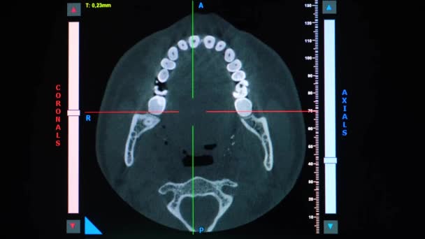 错牙合 缺失咀嚼牙 下颌骨关节功能不全患者的Ct扫描 — 图库视频影像