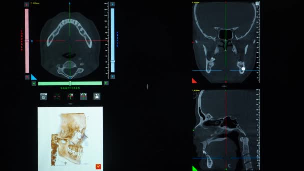 Scan Van Een Patiënt Met Malocclusie Ontbrekende Kauwtand Temporomandibulaire Gewrichtsdisfunctie — Stockvideo