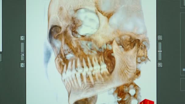 Αξονική Αξονική Τομογραφία Ασθενούς Κακοσμία Που Δεν Έχει Μασήσει Δόντι — Αρχείο Βίντεο