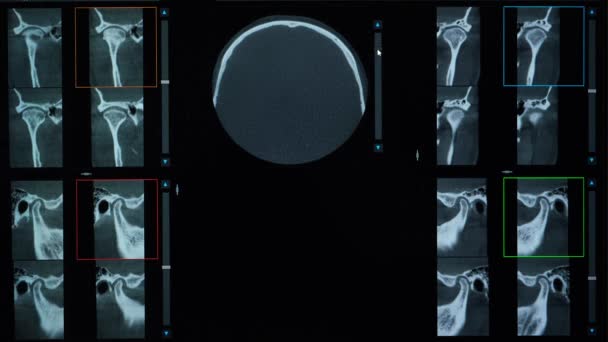 Tomografide Malocclusion Diş Temporomandibular Eklem Bozukluğu Olan Bir Hastanın Tomografisi — Stok video