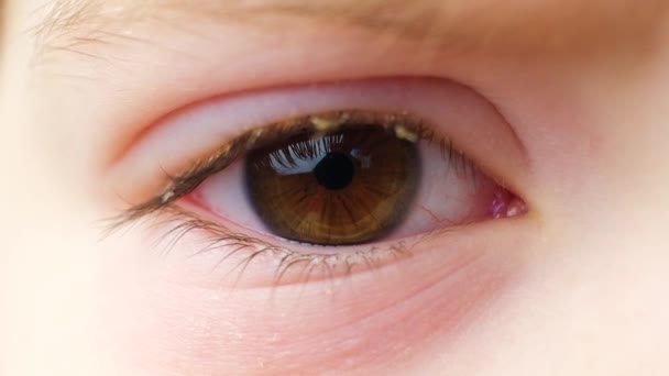 Μάτι 5Χρονου Παιδιού Επιπεφυκίτιδα Φλεγμονή Του Επιπεφυκότα Κοντινό Πλάνο Παιδιατρική — Αρχείο Βίντεο