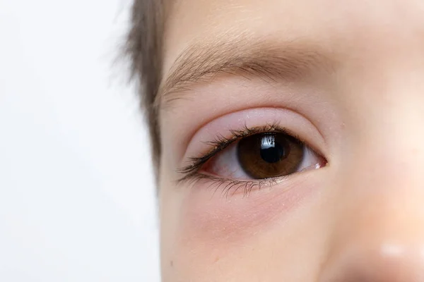 Olho Uma Criança Anos Com Conjuntivite Inflamação Conjuntiva Close Oftalmologia — Fotografia de Stock