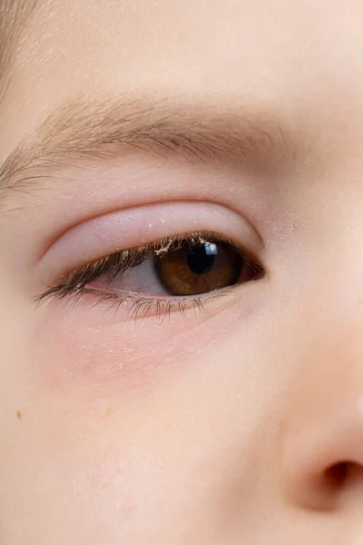 Eye of a 5-year-old child with conjunctivitis, inflammation of the conjunctiva, close-up. Pediatric ophthalmology