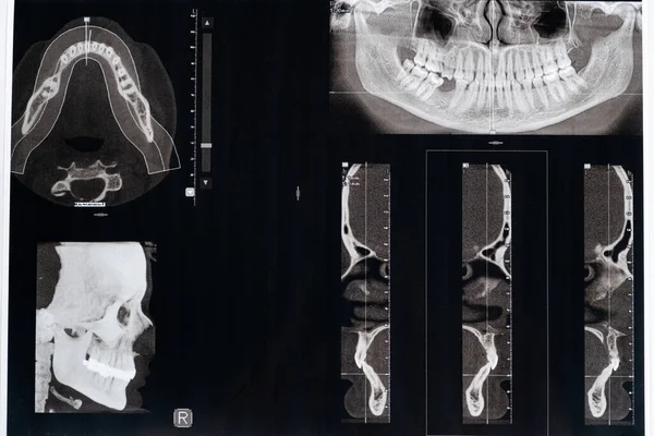 Tomografide Malocclusion Diş Temporomandibular Eklem Bozukluğu Olan Bir Hastanın Tomografisi — Stok fotoğraf